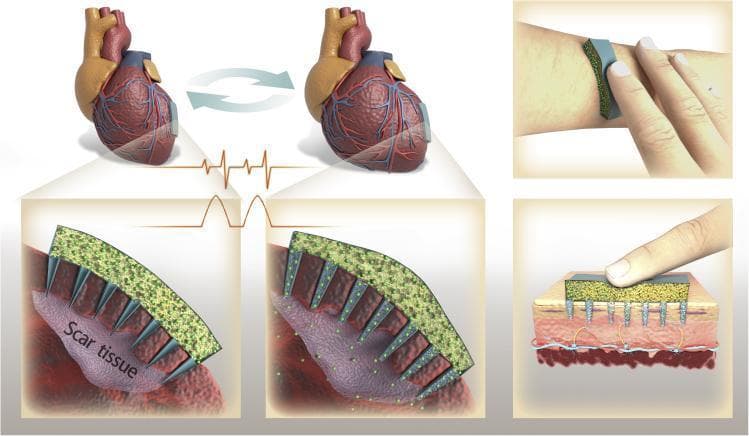 Medical infographic and schematic diagram illustrating a pulsatile drug delivery microneedle patch for cardiac and transdermal applications. The diagram depicts a device consisting of a porous sponge-like drug reservoir (container) integrated with an array of hollow microneedles.
In the cardiac repair scenario, the patch is shown applied to the left ventricle of a human heart. Magnified views demonstrate the microneedles penetrating dense, purple-toned 'Scar tissue' (myocardial infarction site). Synchronized with an electrocardiogram (ECG) waveform, the diagram illustrates how mechanical compression of the sponge container during cardiac contraction forces the release of drug particles (green spheres) into the infarcted tissue.
In the transdermal scenario, the device is applied to the forearm skin. A cross-sectional view shows a finger applying pressure to the patch, illustrating 'on-demand' delivery. The microneedles are seen penetrating the epidermal and dermal layers, reaching toward subcutaneous vascular structures. The graphic demonstrates two distinct clinical uses: targeted regenerative therapy for acute myocardial infarction and localized anesthesia via transdermal on-demand administration.