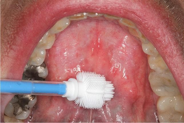 This intraoral clinical photograph displays the floor of the mouth in an adult patient, oriented with the tongue likely elevated. The mucosa of the anterior floor of the mouth exhibits areas of homogeneous leukoplakia—distinct white, well-demarcated patches—on both the left and right sides. The surrounding tissue shows generalized erythema and an irregular texture, suggesting chronic irritation or a precancerous state. An Orcellex cell collector (a specialized white-bristled brush with a blue handle) is positioned over the lesion on the left side, demonstrating a liquid-based cytology collection procedure for diagnostic screening. The visible mandibular dentition shows signs of dental wear, attrition, and significant restorative work, including a large silver-colored amalgam filling on a posterior molar. This image is used for educational purposes to illustrate the clinical appearance of potentially malignant oral mucosal lesions and the methodology for non-invasive brush biopsy sampling.