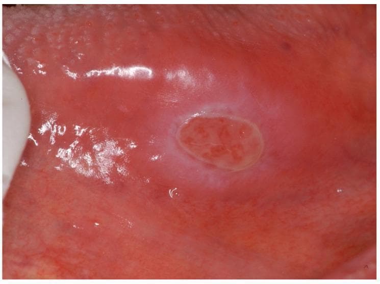 This clinical photograph displays a solitary, well-demarcated oral eosinophilic ulcer, also known as a Traumatic Ulcerative Granuloma with Stromal Eosinophilia (TUGSE). The lesion is located on the lateral border of the tongue, extending toward the ventral surface. The ulcer is characterized by an oval-shaped, erythematous central bed showing irregular texture and granulated tissue. A diagnostic hallmark visible here is the prominent, raised, indurated border with a pale or whitish fibrinous appearance, which clearly separates the ulcer from the surrounding inflamed (erythematous) mucosa. The surrounding tongue tissue appears smooth and lacks the typical papillary texture, likely due to local inflammation. This image is representative of an inflammatory reactive lesion often triggered by trauma. It is a key educational resource for distinguishing benign, self-limiting eosinophilic ulcers from more aggressive conditions like oral squamous cell carcinoma or major aphthous ulcers in clinical dentistry and oral pathology.