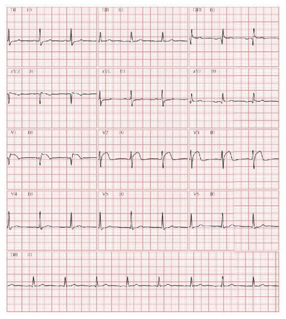 A 12-lead electrocardiogram (ECG) tracing demonstrating acute ischemic changes. The primary diagnostic finding is significant ST-segment elevation in the anterior precordial leads V1, V2, and V3, with V2 and V3 showing peak morphology and upright T waves, consistent with an acute ST-elevation myocardial infarction (STEMI) pattern. Reciprocal ST-segment depression is visible in the inferior leads (II, III, and aVF). The rhythm shows an ectopic atrial rhythm, characterized by P-wave morphology differing from the normal sinus rhythm. Small Q waves or an 'inferior inactive zone' are suggestive of old or evolving inferior wall changes. The QRS duration appears within normal limits. This ECG is a critical diagnostic tool in the emergency management of coronary artery occlusion and serves as an educational example of precordial ST-elevation with associated inferior reciprocal changes.
