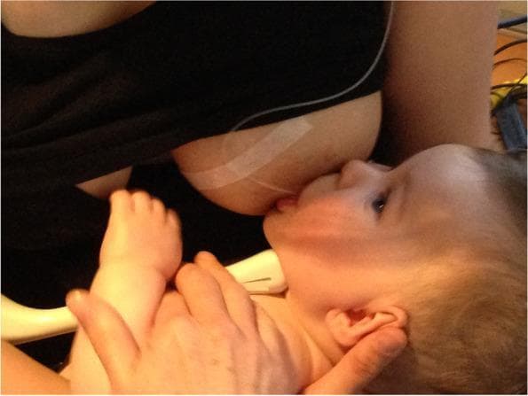 This clinical photograph captures a lateral view of an infant attempting to latch onto the maternal breast during a breastfeeding assessment. The infant is positioned in a supine or slightly reclined posture, supported by a caregiver's hand near the base of the skull and neck. The infant's mouth is partially open, engaging with the nipple and areola, with visible head extension and an upward gaze. A distinctive white adhesive marker or tape is applied to the superior aspect of the breast, serving as a landmark for simultaneous ultrasound imaging as indicated by the presence of an ultrasound transducer positioned submentally against the infant's jawline. The breast tissue appears moderate in size with normal skin pigmentation, though the nipple is elongated within the latch. This image serves as a procedural reference for evaluating breastfeeding mechanics, particularly the 'fit and hold' and intra-oral breast tissue volume before clinical intervention in a case involving maternal nipple pain and post-frenotomy complications.