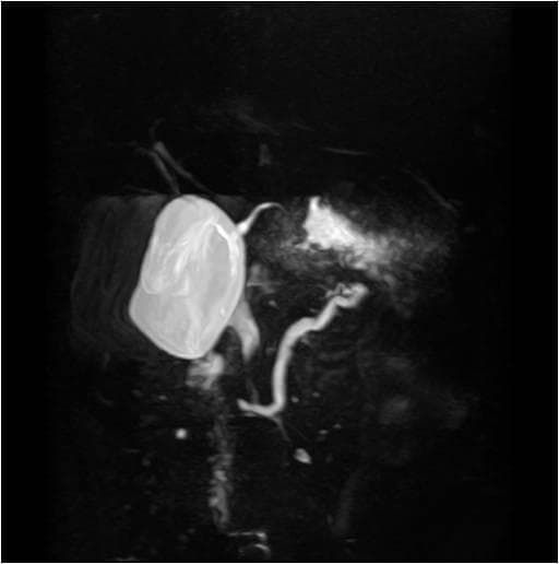 This diagnostic image is a Magnetic Resonance Cholangiopancreatography (MRCP) showing the biliary and pancreatic ductal systems. The primary finding is pancreas divisum, a congenital anatomical variant where the dorsal and ventral pancreatic ducts fail to fuse. The image demonstrates a prominent, slightly dilated dorsal pancreatic duct that crosses over the common bile duct to drain into the minor papilla. A focal narrowing or stenosis is visible at the level of the minor papilla. In contrast, the ventral pancreatic duct appears smaller and normal in morphology, draining separately into the major papilla without any communication with the dorsal duct. The gallbladder and common bile duct are also visualized, with the latter showing mild dilatation. This MRCP finding is clinically significant for diagnosing pancreas divisum, which can be associated with recurrent pancreatitis or obstructive symptoms if drainage through the minor papilla is impaired.