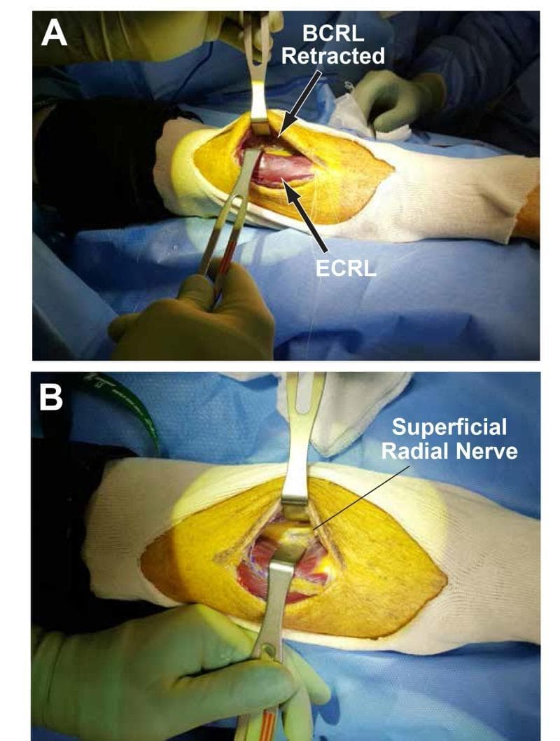 Clinical intraoperative photographs demonstrating a surgical approach to the forearm. Figure A shows an open incision with the brachioradialis (BCRL) and extensor carpi radialis longus (ECRL) muscles identified. Self-retaining or handheld retractors are used to develop the plane between these two muscle bellies using blunt dissection. Figure B illustrates deeper exposure achieved through further lateral retraction of the brachioradialis. This maneuver reveals the superficial radial nerve, which appears as a pale, cord-like longitudinal structure situated in the deep plane. The surgical field highlights the relevant anatomy for decompression of the radial nerve or its branches, such as in cases of posterior interosseous nerve (PIN) entrapment. The images serve as an educational guide for surgical planes in the proximal forearm, emphasizing the relationship between mobile wad musculature and the radial nerve's sensory branch.