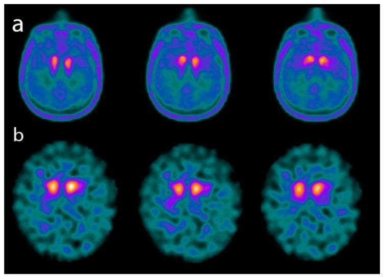 This diagnostic comparison image presents axial brain scans from two different functional imaging modalities: 18F-Fluoro-L-dopa (FDOPA) PET (row a) and 123I-FPCIT (DATSCAN) SPECT (row b). The images illustrate the neurochemical profile of patients with advanced dementia with Lewy bodies (DLB). Both rows demonstrate a characteristic reduction in radiotracer uptake within the basal ganglia, specifically the striatum (caudate nucleus and putamen). In row (a), the FDOPA PET scans show diminished metabolic activity in the dopaminergic system, indicated by the reduced intensity and area of the warm colors (yellow/red) compared to healthy controls. In row (b), the DATSCAN SPECT images reveal a severe decrease in dopamine transporter (DAT) availability, represented by the restricted and weakened signal in the striatal regions. The surrounding cortical and subcortical brain tissue displays low, uniform background uptake in both modalities, primarily in cooler blue and green tones. This visual comparison highlights the integrated role of PET and SPECT imaging in identifying presynaptic dopaminergic deficits, a core diagnostic feature for differentiating alpha-synucleinopathies like DLB from other dementias such as Alzheimer’s disease.