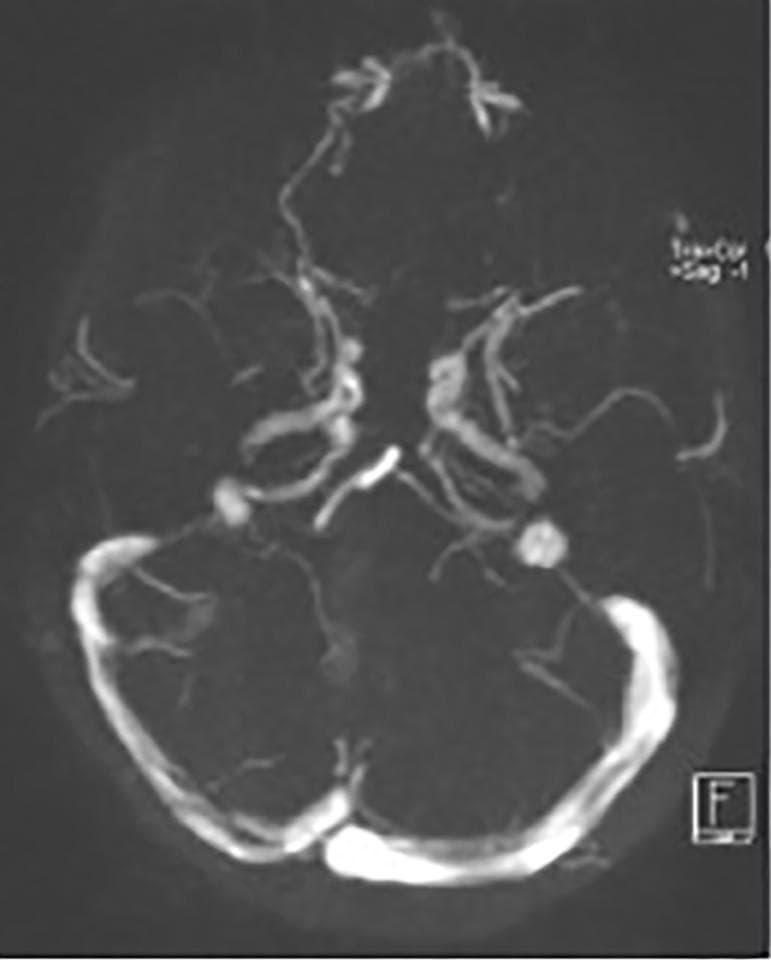 This diagnostic image is an axial view of a head MRI (MR Venogram), specifically highlighting the intracranial dural venous sinuses and cerebral veins through contrast enhancement. The image demonstrates the anatomy of the posterior cranial fossa drainage system, including the confluence of sinuses (torcular herophili) and the bilateral transverse sinuses. The superior sagittal sinus is visible along the midline, while smaller cortical veins appear as thin, tortuous branching structures extending toward the frontal and temporal lobes. A notable finding is the caliber difference or filling defect in the right transverse sinus compared to the contralateral side, which is clinically significant for evaluating cerebral venous sinus thrombosis (CVST). The skull base and anatomical landmarks are faintly outlined, providing structural context for the vascular pathways. This imaging modality is essential for identifying vascular occlusions or anatomical variations in the venous drainage of the brain.