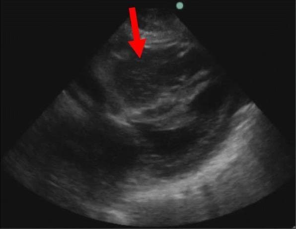 This diagnostic image is a point-of-care ultrasound (POCUS) echocardiogram, likely from a subxiphoid or parasternal view, demonstrating significant pathology in a patient during cardiac arrest. The image reveals a prominent, dilated right ventricle containing a heterogeneous, echogenic mass (indicated by a red arrow). This visual finding is characteristic of a large coagulum or blood clot formation, often associated with massive pulmonary embolism as an underlying cause of cardiac arrest. In comparison, the left ventricle appears markedly underfilled and compressed, exhibiting reduced chamber size relative to the right side. The overall appearance highlights the loss of normal cardiac chamber proportions and the presence of intracavitary thrombus, which are critical diagnostic markers in emergency resuscitation settings. This visual serves as an educational example of identifying reversible causes of cardiac arrest, such as obstructive shock, using real-time ultrasonography.