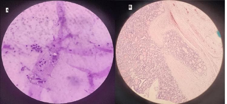 This comparative diagnostic image presents two different pathological preparations of a follicular thyroid nodule. Panel A displays a Fine-Needle Aspiration Cytology (FNAC) smear, characterized by dispersed individual follicular cells with small, dark purple-stained nuclei. The background contains amorphous light purple extracellular material and thin fibrous strands, representing a benign cytological appearance (Bethesda Category II). Panel B shows a postoperative histopathological section stained with Hematoxylin and Eosin (H&E) at 40x magnification. This section demonstrates a structured follicular architecture consisting of varied-sized thyroid follicles lined by follicular epithelium. Key features include dense follicular crowding and a prominent pink-stained fibrous capsule with clear evidence of neoplastic tissue invasion. The visual comparison highlights the diagnostic progression from benign cytological features to a definitive histological diagnosis of follicular thyroid carcinoma based on capsular invasion, a finding not visible on cytology alone. The image is intended for medical education regarding the limitations of FNAC and the surgical pathology of thyroid malignancies.