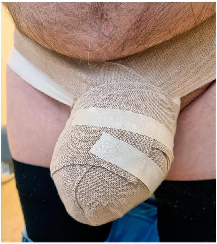 A clinical photograph of the male pelvic region demonstrating the application of low-stretch compression bandages for the management of secondary genital lymphedema. The tan, woven, short-stretch bandages are meticulously wrapped around an enlarged penis and scrotum, creating a bulbous, reinforced mass secured with white adhesive medical tape. The bandaging extends around the waist to provide a stable anchor. The patient is wearing white briefs as a base layer, and dark-colored garments (likely compression stockings or trousers) are visible on the upper thighs. This image illustrates a key component of Complete Decongestive Therapy (CDT) used to reduce edema volume, manage skin tension, and prevent complications like cellulitis in patients with lymphatic obstruction following oncological treatment, such as rectal cancer surgery. The focus is on the specialized bandaging technique required for complex anatomical regions where standard compression garments may be inadequate.