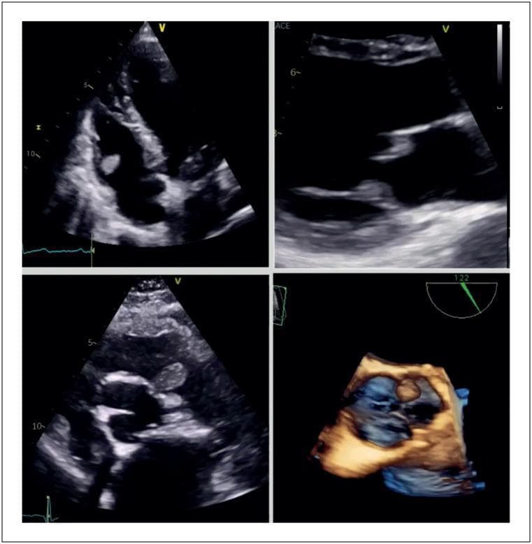This composite diagnostic image features four echocardiographic views (three 2D grayscale transthoracic images and one 3D color-rendered reconstruction) demonstrating papillary fibroelastomas on all four cardiac valves. The images highlight these benign primary cardiac tumors as small, pedicled, and highly mobile masses attached to the valvular endocardium. Clockwise from top-left, the masses are located on the tricuspid valve anterior leaflet, the mitral valve anterior leaflet, the aortic valve left cusp (3D view), and the pulmonic valve left cusp. Key sonographic features include a speckled internal echogenicity with focal areas of echolucency and a characteristic filamentous or stippled surface appearance at the margins. The 3D reconstruction provides enhanced spatial orientation and surface morphology of the fibroelastoma on the aortic valve. These findings are clinically relevant for distinguishing benign tumors from vegetations or thrombi, particularly given their potential for embolic complications.