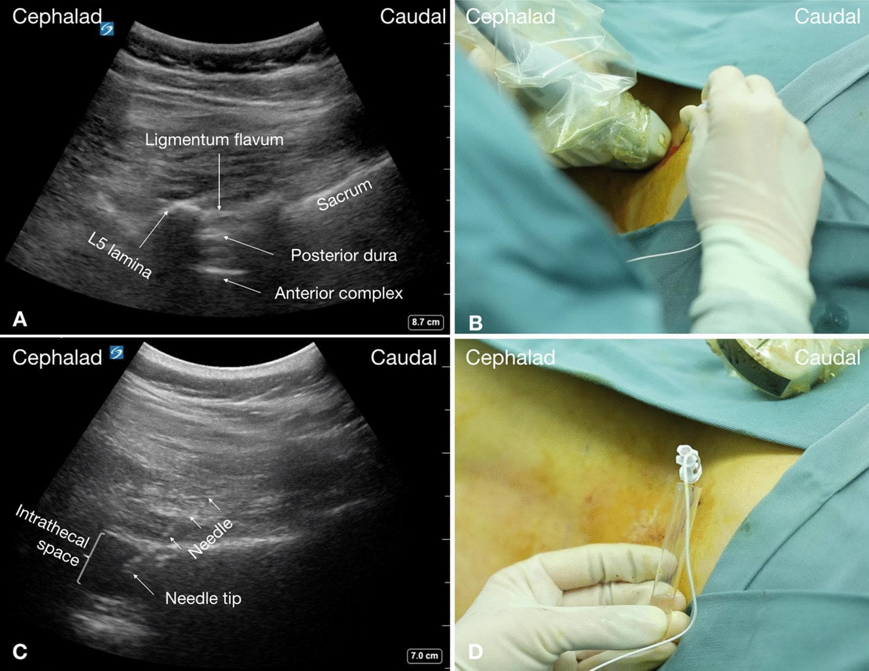 A four-panel medical illustration demonstrating a real-time ultrasound-guided lumbar puncture in a patient with Spinal Muscular Atrophy (SMA) and severe scoliosis. Panel A shows a paramedian sagittal oblique sonogram of the L5–S1 lumbar spine. Key sonoanatomical landmarks are identified: the hyperechoic L5 lamina and sacrum, the hyperechoic ligamentum flavum, the posterior dura, and the deep anterior complex (anterior dura, posterior longitudinal ligament, and vertebral body). The anechoic space between the posterior dura and anterior complex represents the intrathecal space. Panel B is a clinical photograph showing the placement of a curvilinear ultrasound transducer in a sterile sheath, with a needle advanced using an in-plane, caudal-to-cephalad approach. Panel C is a real-time sonogram showing the echogenic needle and its tip successfully positioned within the anechoic intrathecal space. Panel D confirms successful access with a clinical photograph showing the free flow of clear cerebrospinal fluid (CSF) from the hub of the puncture needle. This procedure illustrates an advanced neuraxial technique for patients with complex spinal anatomy requiring intrathecal medication administration.