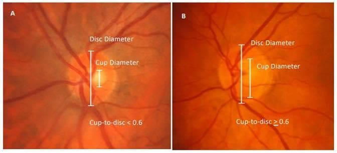 Side-by-side comparative fundus photographs showing the measurement of the optic cup-to-disc ratio (CDR), a critical metric in glaucoma screening and ophthalmic diagnostics. Panel A displays a healthy optic disc with a small central excavation, annotated with vertical bars indicating the 'Disc Diameter' and a significantly smaller 'Cup Diameter,' resulting in a CDR < 0.6. Panel B demonstrates an enlarged optic cup where the excavation occupies a greater vertical proportion of the disc, annotated with a CDR ≥ 0.6. This pathological enlargement, or 'cupping,' indicates neuroretinal rim thinning. In both images, retinal blood vessels are visible originating from the optic disc and branching across the fundus. The comparison highlights morphological changes in the optic nerve head, specifically the expansion of the cup relative to the disc margin. This material is designed for medical educational purposes to teach the quantitative assessment of vertical CDR and the identification of clinical markers for glaucomatous optic neuropathy.