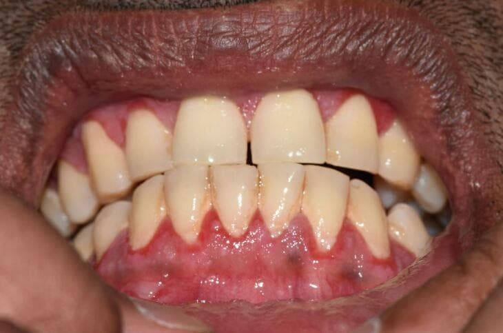This clinical photograph shows an intraoral view of the maxillary and mandibular anterior dentition and associated periodontium. The primary finding is desquamative gingivitis, characterized by a diffuse, intense erythematous appearance of the marginal and attached gingiva. The gingival tissues exhibit a glossy, friable texture with a complete loss of normal stippling. The interdental papillae are edematous, blunted, and appear painfully inflamed. These clinical features are highly suggestive of Mucous Membrane Pemphigoid (MMP), an autoimmune blistering disease where the epithelium separates from the underlying connective tissue. The teeth themselves are relatively well-aligned with yellowish-white enamel and visible cervical plaque accumulation, which may exacerbate the gingival inflammatory response. This image serves as a classic educational example of desquamative gingivitis associated with systemic vesiculobullous disorders, highlighting the need for biopsy and immunofluorescence for definitive diagnosis.