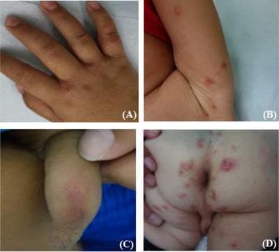 This composite clinical photograph illustrates the diverse dermatological manifestations of scabies in a pediatric patient across four anatomical regions. Panel A shows the dorsal hand and interdigital spaces featuring erythematous papules, papulovesicles, and distinct blisters. Panel B displays the axillary region with scattered red papules and inflammatory nodules. Panel C depicts the genital area (penis) presenting with characteristic pruritic red nodules, where subtle linear, whitish 'tunnels' or burrows—pathognomonic for Sarcoptes scabiei infestation—are visible on the nodular surfaces. Panel D captures the buttocks and perianal area showing extensive polymorphic lesions, including widespread erythema, inflammatory papules, and nodules interspersed with secondary lesions such as excoriations (scratches), shallow ulcers, and hemorrhagic scabs resulting from chronic pruritus. The collection serves as an educational reference for identifying both primary sarcoptic lesions and secondary infections or irritations common in childhood scabies cases.