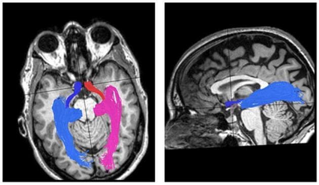 This diagnostic image demonstrates the reconstruction of human visual pathways using Diffusion Tensor Imaging (DTI) tractography superimposed on T1-weighted MRI scans. The left panel shows an axial view of the optic tracts and optic radiations. The right optic tract is color-coded red, and the left is dark blue, both originating near the optic chiasm and extending posteriorly to the lateral geniculate nucleus (LGN). The subsequent optic radiations are depicted in pink (right) and light blue (left), projecting from the LGN toward the calcarine cortex in the occipital lobes. The right panel displays a sagittal view focused on the left visual pathway (blue), illustrating the longitudinal trajectory from the anterior chiasm region, through the temporal lobe (including Meyer’s loop), to the posterior primary visual cortex. This visualization is used in neuroimaging to evaluate the structural integrity and connectivity of white matter tracts in clinical conditions such as optic neuritis, multiple sclerosis, or space-occupying lesions like meningiomas.