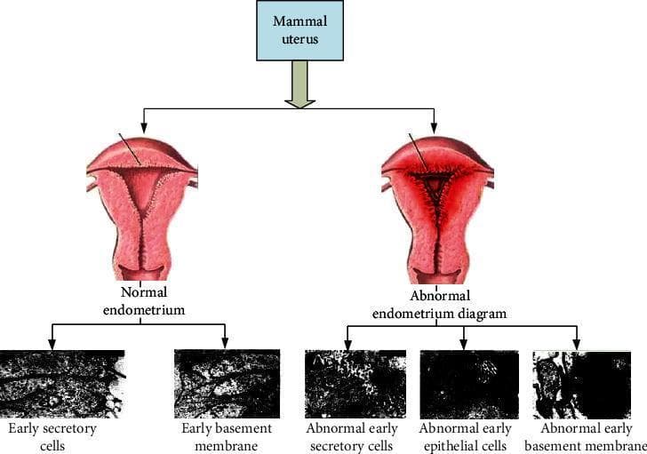 An educational comparison diagram illustrating the differences between normal and abnormal endometrium (specifically endometriosis). The top section displays two anatomical illustrations of a mammal uterus. The 'Normal endometrium' shows a smooth, uniform uterine cavity with an open, Y-shaped internal structure. The 'Abnormal endometrium diagram' depicts a constricted, triangular uterine cavity with thickened, irregular linings and growths, suggestive of ectopic tissue implantation. The bottom section presents five high-magnification grayscale diagnostic images representing cellular pathology. The normal side shows 'Early secretory cells' and 'Early basement membrane' with visible, organized textures and clear cellular arrangements. In contrast, the abnormal side shows 'Abnormal early secretory cells,' 'Abnormal early epithelial cells,' and 'Abnormal early basement membrane,' which exhibit significantly darker, less defined clusters and disrupted structural integrity. This diagram serves as a visual guide to the gross anatomical and microscopic cellular changes associated with endometrial pathology.
