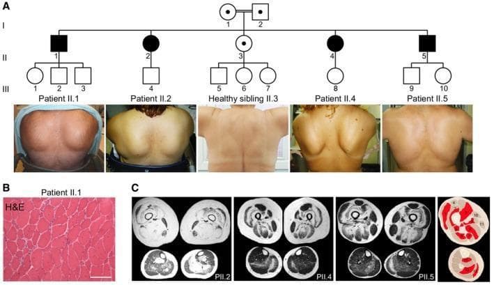 Educational panel illustrating the clinical, genetic, and radiological features of Limb-Girdle Muscular Dystrophy (LGMD) caused by a POGLUT1 mutation. Panel A presents a family pedigree indicating autosomal recessive inheritance, alongside clinical photographs showing bilateral scapular winging and muscular atrophy in affected siblings compared to a healthy control. Panel B displays a high-magnification Hematoxylin and Eosin (H&E) stained skeletal muscle biopsy from an affected patient, demonstrating a moderate-to-severe dystrophic pattern characterized by fiber size variability, rounded fibers, and increased connective tissue (scale bar: 50 ̀̀m). Panel C shows T1-weighted axial MRI sections of the thigh and calf from three patients. The images reveal progressive fatty degeneration with a characteristic 'inside-to-outside' distribution, where internal muscle regions show high signal intensity (fatty replacement) while external borders are relatively spared. Notable patterns include the sparing of the rectus femoris, sartorius, and gracilis in the thigh, and diffuse involvement of the soleus in the calf. This visual summary correlates genetic pedigree with phenotypic manifestations and diagnostic imaging in neuromuscular disease.