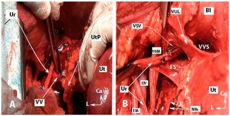 Two intraoperative clinical photographs (A and B) demonstrate key anatomical dissections during a nerve-sparing radical hysterectomy. Image A shows the transection of the vaginal vein (VV) and the medial mobilization of the uterine pedicle (UtP) to expose the ureteral tunnel. The ureter (Ur) is visible laterally as it courses toward the bladder. Image B illustrates the development of the 'Fourth space' (FS), a surgical avascular plane located between the ureter (Ur) and the vesicouterine ligament (VUL). Key vascular structures including the external iliac artery (EIA), external iliac vein (EIV), and umbilical artery (UMA) are identified. The vesical superficial vein (VSV) and vesicocervical vessels have been coagulated and transected. Notably, bladder nerve branches (NBs) are preserved, extending from the inferior hypogastric plexus toward the bladder (Bl). This educational material emphasizes surgical landmarks and planes necessary to prevent autonomic nerve injury during pelvic oncologic surgery.
