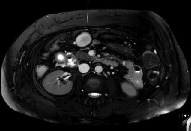 This diagnostic image is an axial T2-weighted MRI slice of the upper abdomen focusing on the hepatobiliary and pancreatic regions. The liver exhibits a nodular surface and coarse signal, characteristic of cirrhosis. Significant secondary findings of portal hypertension are visible, including multiple splenic varices and a prominent, well-defined ovoid structure located anterior to the pancreatic head. This structure, measuring approximately 40 x 28 mm, demonstrates high T2 signal intensity and is adjacent to regional vasculature. The primary educational focus of this image is the recognition of vascular complications associated with end-stage liver disease, specifically the development of varices and portal-systemic shunts. The image also captures the kidneys, aorta, and vertebral column, providing anatomical context for the pathology located in the anterior-superior abdominal quadrant. Clinical relevance includes the diagnostic workup of portal hypertension and the differentiation of vascular lesions from solid pancreatic or mesenteric masses.