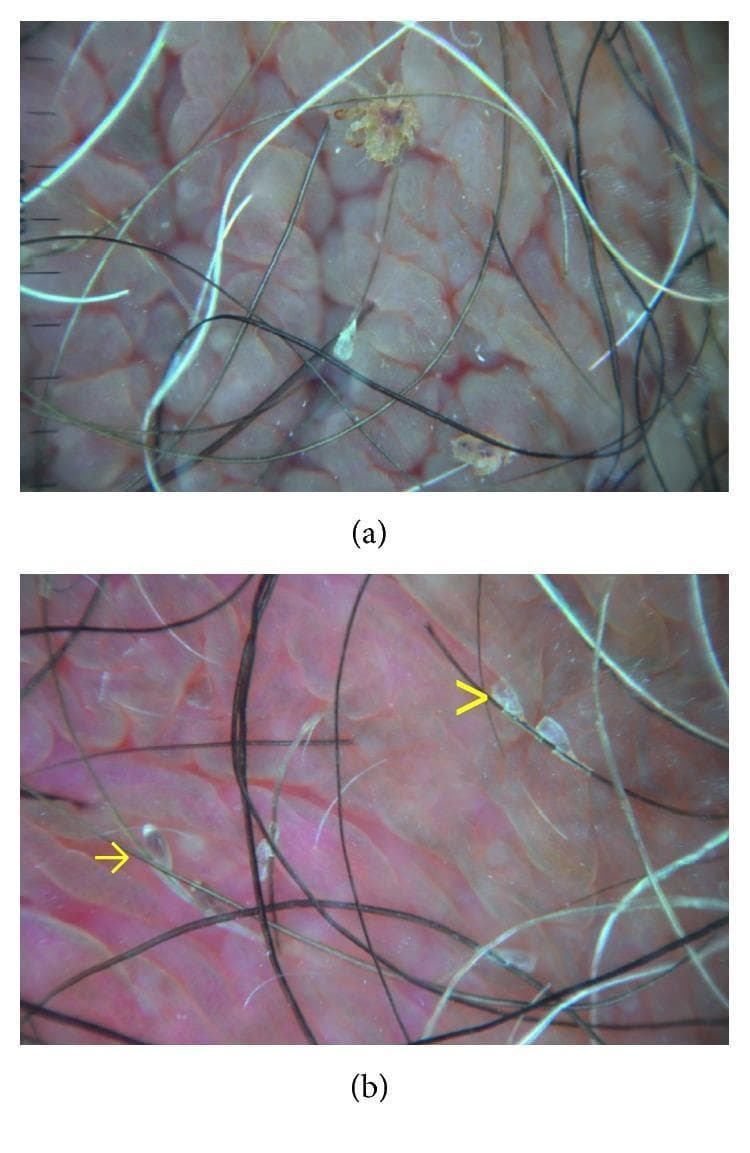This composite clinical diagnostic image displays dermatoscopic findings of pediculosis pubis (crab lice) on the human genital area. Image (a) shows a high-magnification view of two adult Pthirus pubis parasites firmly attached to pubic hair shafts. The organisms appear as brownish, translucent, multi-segmented crab-like bodies with visible appendages. Image (b) highlights the presence of nits at various stages. Ovoid, brownish, and convex structures indicated by yellow arrows represent full nits containing unhatched eggs. In contrast, the translucent, flat, and fissured structures marked by yellow arrowheads represent empty nit casings after hatching. The background shows characteristic pinkish, lobulated skin texture. These dermatoscopic features are critical for distinguishing active infestations from resolved ones, providing a rapid, non-invasive method for diagnosis and post-treatment follow-up in dermatology and sexual health settings.