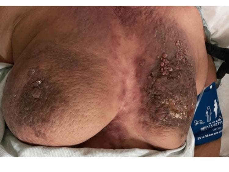 This clinical photograph displays a frontal view of the anterior chest wall, showcasing advanced dermatological manifestations of bilateral breast pathology. Both breasts exhibit significant erythema, diffuse hyperpigmentation, and the characteristic 'peau d'orange' texture, which is indicative of dermal lymphatic invasion. The left breast demonstrates more severe involvement, including extensive nodular skin thickening, verrucous (wart-like) skin nodules, and a retracted nipple. Additionally, a focal area of frank skin ulceration and crusting is visible on the left breast, associated with an underlying tumor mass. The right breast shows similar but less advanced findings with prominent nipple retraction and peau d'orange changes. These visual signs are classic clinical indicators of inflammatory breast cancer or advanced metastatic breast carcinoma with cutaneous involvement.