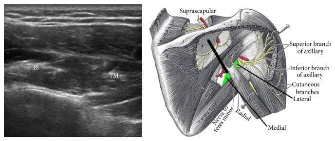 The visual content consists of two side-by-side images: a musculoskeletal diagnostic ultrasound (left) and an anatomical diagram of the posterior shoulder (right), illustrating the positioning for ultrasound-guided procedures. The ultrasound shows a short-axis view of the myotendinous junction within the infraspinatus fossa. Two distinct muscle groups are identified: the infraspinatus (IS) and the teres minor (TM), appearing as relatively hypoechoic structures with characteristic fibrillar echotexture separated by fascial planes. The anatomical diagram depicts the posterior aspect of the scapula and proximal humerus, highlighting the rotator cuff muscles, axillary nerve branches (superior and inferior), and the radial nerve. A thick black line on the diagram indicates the transducer's orientation, placed perpendicular to the axis of the spine of the scapula. This clinical setup is primarily used for identifying landmarks during ultrasound-guided axillary nerve blocks or diagnostic assessments of rotator cuff pathology. The educational focus is on correlating surface anatomy and transducer placement with real-time sonographic visualization of posterior shoulder musculature and neurovascular landmarks.