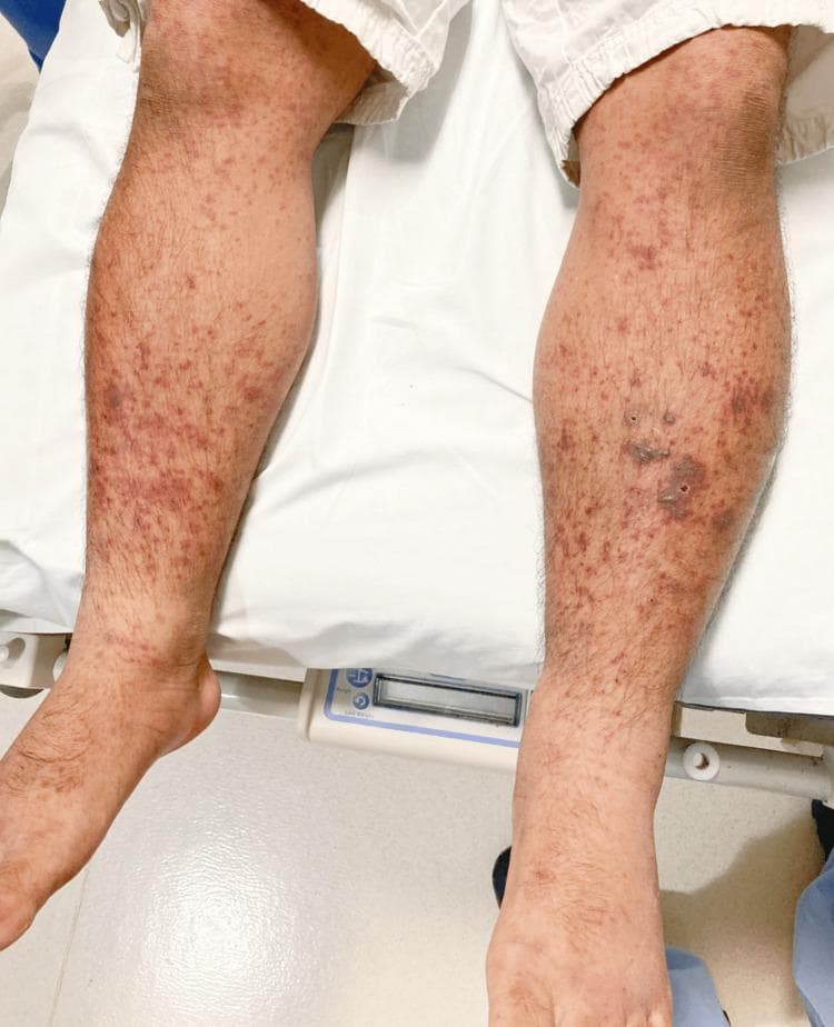This clinical photograph displays a bilateral, symmetric palpable purpuric rash on the lower extremities of an adult male. The lesions extend from the dorsal feet and ankles up to the lower thighs. The primary morphology consists of numerous non-blanching, reddish-purple macules and papules that vary in size from pinpoint petechiae to larger, confluent ecchymotic patches. On the anterior and lateral aspects of the legs, the lesions are densely packed, with some appearing as dark necrotic-looking areas or small ulcerations, particularly on the right leg. The background skin shows mild surrounding erythema without significant scaling or edema. This presentation is characteristic of small-vessel vasculitis, specifically IgA vasculitis (Henoch-Schönlein purpura), which typically presents with this gravity-dependent distribution. The image serves as a classic educational example of palpable purpura, a hallmark sign of systemic vasculitis often involving the skin, gastrointestinal tract, and kidneys.