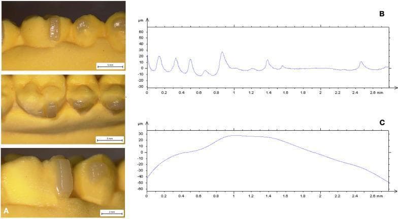 This composite educational graphic details the surface characteristics of orthodontic attachments on a dental resin model. Panel A presents intraoral clinical photographs of a 3D-printed yellow resin dental arch featuring translucent, rectangular composite attachments bonded to the buccal surfaces of the teeth. These attachments appear smooth and glossy, indicative of a well-cured conventional nanocomposite (CNC). Panels B and C are linear surface profile graphs obtained via a contact probe surface profiler. Graph B illustrates the 'surface roughness' profile, displaying frequent, sharp micro-peaks and valleys ranging from approximately -15 µm to +30 µm, which represent localized material irregularities. Graph C illustrates the 'surface waviness' profile, showing a smoother, broader undulating curve representing macro-level variations in surface height across the 2.6 mm measurement length. This data is used in orthodontics to evaluate the quality and precision of clear aligner attachments cured with specialized light-guide tools, comparing surface integrity and morphological accuracy between different composite materials.
