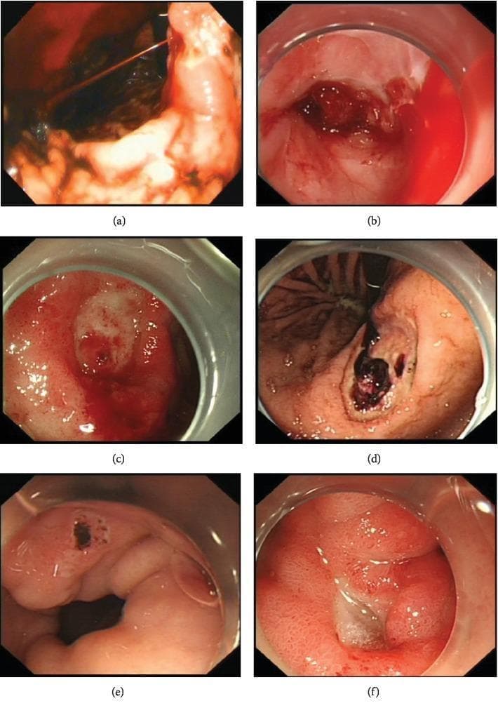 A composite of six endoscopic images illustrating the Forrest classification for upper gastrointestinal bleeding risk assessment in peptic ulcer disease. (a) Forrest Ia: demonstrates active, high-pressure spurting bleeding from an arterial source. (b) Forrest Ib: shows active oozing bleeding without pulsatility. (c) Forrest IIa: displays a non-bleeding visible vessel appearing as a raised, red protuberance within the ulcer bed. (d) Forrest IIb: shows an adherent clot, a dark, thick mass of coagulated blood firmly attached to the ulcer. (e) Forrest IIc: depicts a flat, pigmented spot (haematin) indicating recent hemorrhage. (f) Forrest III: shows a clean-based ulcer with a white or yellow fibrin base and no signs of recent bleeding. This series is a critical educational tool for gastroenterology to differentiate between high-risk (Ia-IIb) and low-risk (IIc-III) lesions, guiding endoscopic intervention and pharmacological management.