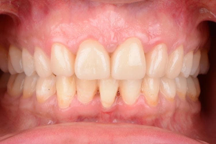 Frontal intraoral clinical photograph showing a five-year follow-up of a patient with congenitally missing maxillary central incisors, now restored with monolithic lithium disilicate crowns. The image demonstrates the esthetic result of orthodontic tooth repositioning, where lateral incisors were moved to the central positions and canines to lateral positions. The maxillary anterior teeth exhibit a uniform off-white shade with a morphology following the 'golden ratio' (central incisor width approximately 1.6 times that of lateral incisors). The gingival tissue shows a scalloped contour, post-esthetic crown lengthening, with slight blunting of the interdental papillae between the maxillary central incisors. The mandibular teeth show signs of mild gingival inflammation and visible dental plaque at the cervical margins. This clinical image illustrates complex multidisciplinary management involving orthodontics, periodontal surgery, and fixed prosthodontics in a patient with a history of cleft palate.