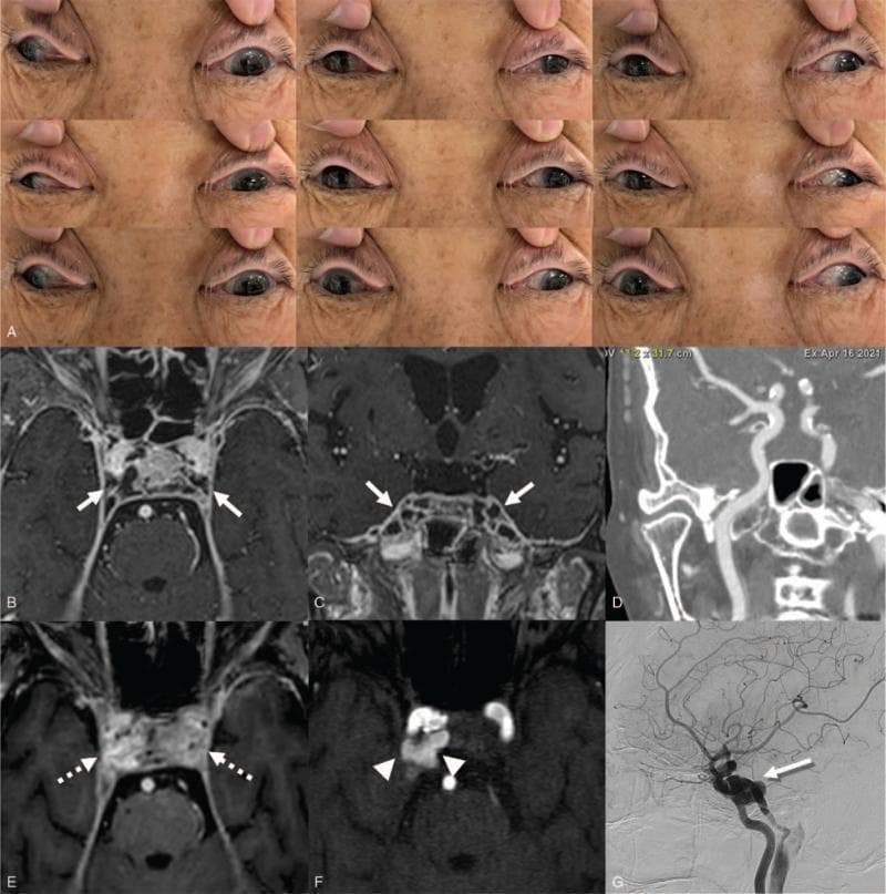 This composite figure illustrates the clinical and radiographic features of septic cavernous sinus thrombosis (SCST) progressing to a carotid-cavernous fistula (CCF). Panel A shows a series of nine cardinal gaze clinical photographs demonstrating bilateral eyelid swelling, incomplete ptosis, and restricted extraocular motility (ophthalmoplegia), notably bilateral exotropia with impaired medial and vertical gaze. Panels B and C are gadolinium-enhanced axial and coronal brain MRI images showing bilateral cavernous sinus expansion with prominent thrombotic filling defects (arrows). Panel D is a CT angiogram of the neck, used to screen for initial arterial involvement. Panel E (follow-up MRI) reveals persistent thrombosis and significant contrast enhancement/enlargement of the cavernous sinuses (dotted arrows). Panel F (Time-of-Flight MR Angiography) displays abnormal high-flow-related signal in the right cavernous sinus (arrowheads), diagnostic of a secondary CCF. Panel G (Digital Subtraction Angiography) confirms the fistula at the distal cavernous segment of the right internal carotid artery (shadowed arrow). The collection documents the evolution of infectious cavernous sinus disease into a vascular complication.