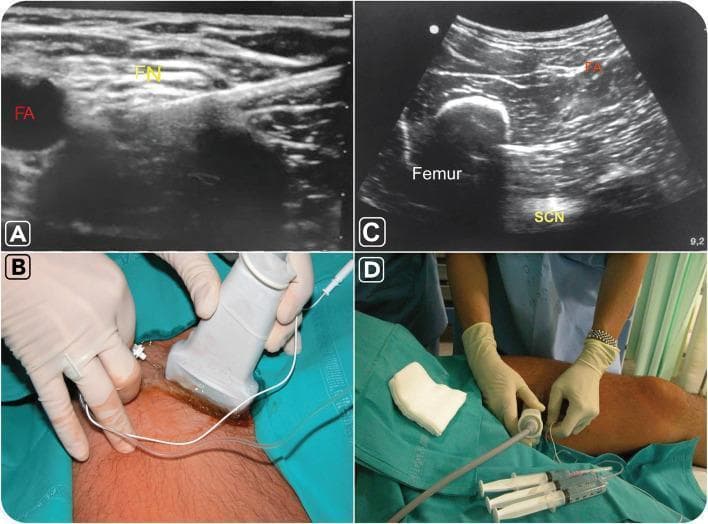 This composite figure illustrates ultrasound-guided nerve block procedures of the lower limb. Panels A and B focus on the femoral nerve block. Image A is a transverse ultrasound view of the femoral region showing the femoral nerve (FN) as a cluster of intermediate echogenicity situated lateral to the anechoic (black) femoral artery (FA). Panel B shows the corresponding clinical setup with a linear transducer placed at the inguinal crease and a needle inserted in-plane. Panels C and D demonstrate the sciatic nerve block via an anterior approach. Ultrasound image C reveals the sciatic nerve (SCN) as a hyperechoic, oval structure located deep to the femur and femoral artery, positioned between the adductor magnus and hamstring muscles at a depth of approximately 6–8 cm. Clinical photograph D displays the positioning for the anterior sciatic block with the patient in a supine position, showing the needle insertion at the medial aspect of the thigh. This visual guide demonstrates key anatomical landmarks and probe positioning for regional anesthesia of the femoral and sciatic nerves.