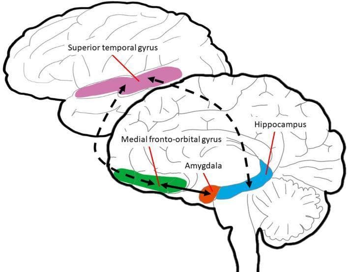 This anatomical diagram provides a schematic representation of the fronto-temporo-limbic network across two neuroanatomical perspectives. The top register displays a lateral view of the human brain, highlighting the Superior Temporal Gyrus (STG) in pink. The lower register illustrates a medial view, identifying three key structures: the Medial Fronto-Orbital Gyrus (mFOG) in green, the Amygdala in red, and the Hippocampus in blue. Black dashed and solid arrows represent structural or functional connectivity pathways between these regions. Spatially, the mFOG is positioned anteriorly, the amygdala is situated at the anterior tip of the temporal lobe, and the hippocampus extends posteriorly from the amygdala. This visual summarizes the neuroanatomical circuit essential for social-emotional processing, facilitating an understanding of the relationship between the prefrontal cortex, temporal lobe, and limbic system. It is designed for medical education regarding brain connectivity and regional functional anatomy.