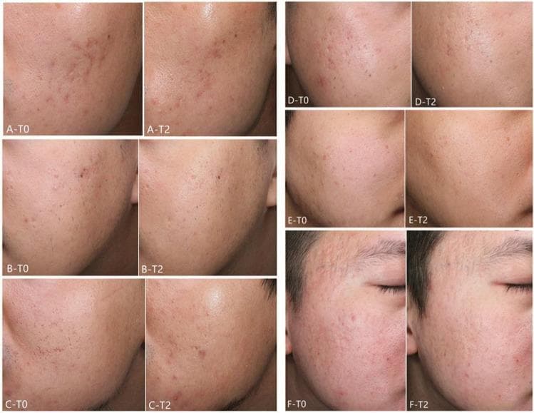 This clinical comparison chart presents side-by-side photographs of six patients (A–F) demonstrating the therapeutic effects of fractional laser treatments on atrophic acne scars. The images are categorized into two groups: Patients A, B, and C received 1927 nm fractional thulium laser (FTL) treatment, while Patients D, E, and F received 2940 nm fractional Er:YAG laser (FEL) treatment. Each pair compares the baseline (T0) to the clinical appearance 12 weeks after the final treatment session (T2). At baseline, the photographs show various morphologies of atrophic scarring, including ice-pick, boxcar, and rolling scars, often accompanied by post-inflammatory erythema and irregular skin texture. The T2 follow-up images demonstrate a visible reduction in scar depth, smoothing of the skin surface, and an overall improvement in skin texture and pigmentation. This visual comparison illustrates the efficacy of fractional resurfacing lasers in remodeling dermal collagen to treat facial acne scarring within a dermatology or aesthetic medicine context.