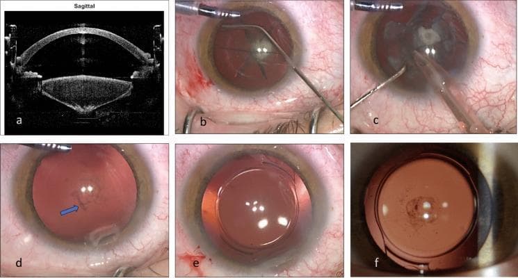 This composite figure illustrates a surgical sequence for Femtosecond Laser-Assisted Cataract Surgery (FLACS) in a patient with a posterior polar cataract. (a) A preoperative sagittal OCT image shows the characteristic posterior bulge of the lens material toward the posterior capsule, with no visible capsular rupture. (b) Intraoperative photograph shows manual hydrodissection using a cannula to separate the lens from the capsule. (c) Phacoemulsification stage, where a central posterior white plaque is manipulated and flipped anteriorly for safe removal. (d) Post-extraction view demonstrating an intact posterior capsule with remnant pigmented dots and a localized surgical scar (arrow) from adhesion removal. (e) Successful implantation of a posterior chamber intraocular lens (PC-IOL) within the intact capsular bag. (f) A one-month post-operative retroillumination photograph showing residual posterior stippling that does not affect visual acuity. This educational series highlights the surgical precautions and diagnostic imaging necessary to manage the risk of posterior capsule rupture in polar cataract cases.