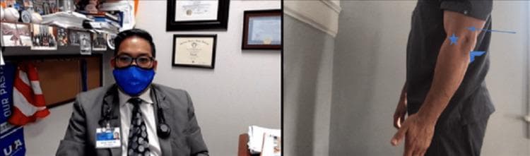 A split-screen educational clinical photograph demonstrating anatomical landmarks of the elbow for use in telemedicine or physical examination instruction. The left panel shows a clinician in a professional setting, providing context for a remote clinical assessment. The right panel displays a lateral view of a patient's left elbow in a slightly flexed position. Three key anatomical structures are annotated on the skin surface using blue graphic overlays: an arrow points to the triceps muscle/tendon area, an arrowhead indicates the bony prominence of the olecranon, and a star symbol marks the location of the lateral epicondyle of the humerus. This visual serves as a guide for surface anatomy identification during an orthopedic evaluation, specifically targeting areas relevant for assessing conditions like lateral epicondylitis, triceps tendinopathy, or olecranon bursitis.