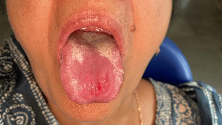 An intraoral clinical photograph showing the dorsal surface of the tongue of a patient with median rhomboid glossitis. The image demonstrates a well-circumscribed, erythematous, and depapillated area centrally located on the midline of the tongue, anterior to the circumvallate papillae. The lesion exhibits a smooth, atrophic texture compared to the surrounding normal filiform papillae. Within this central erythematous zone, there is a small, focal area of ulceration with minor pinpoint bleeding. Faint, irregular white patches are visible along the lateral and posterior margins of the depapillated area, suggestive of secondary candidal infection (pseudomembranous candidiasis). The surrounding oral mucosa and lips appear clinically normal. This visual presentation is characteristic of a 'kissing lesion' associated with oral thrush, showing evidence of early healing or partial response to antifungal therapy as indicated by the reduction in the size of the central ulcer and thinning of the white coating.