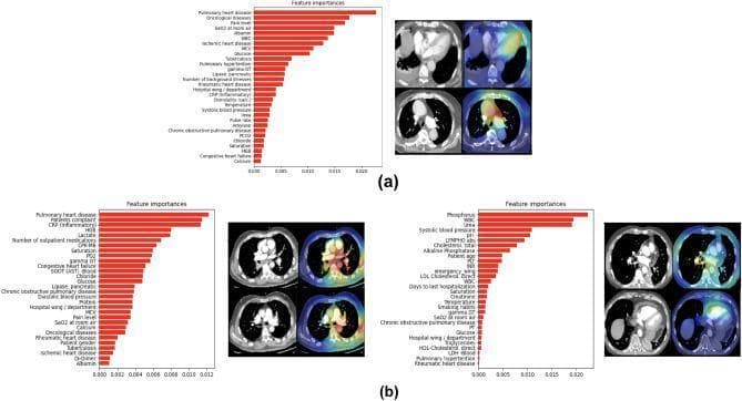 This infographic presents misclassified examples from a multimodal classifier designed for Pulmonary Embolism (PE) risk stratification, comparing Electronic Health Record (EHR) features and 3D CT Pulmonary Angiography (CTPA) imaging. (a) Displays a false negative case featuring a bar chart of EHR feature importance (e.g., Pulmonary heart disease, Patients Complaint, CRP) and corresponding 3D Grad-CAM heatmaps overlaying the left ventricle and pulmonary artery. (b) Shows two false positive examples with their respective feature importance rankings (including Phosphorus, WBC, and Urea) and Grad-CAM visualizations. The heatmaps in these cases highlight the pulmonary trunk, aorta, right ventricle chamber, and areas indicating potential PE clots. This visual provides an educational comparison of how deep learning models utilize diverse data modalities to assess acute PE severity, illustrating anatomical regions of high diagnostic importance such as the heart chambers and major thoracic vessels. It serves as a study of model interpretability and the clinical relevance of multimodal diagnostic fusion.
