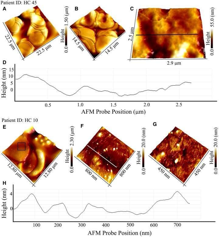 This composite diagnostic image presents Atomic Force Microscopy (AFM) analysis of red blood cell (RBC) membrane topography from two different subjects (HC-45 and HC-10). The figure comprises 3D-rendered topographical maps and corresponding sectional height profiles. Panels A-C display RBCs from subject HC-45, showing a relatively smooth, featureless membrane surface; the sectional profile in Panel D reveals broad, low-frequency height variations (up to 15 nm) attributed to natural cell corrugation and minor lipid bilayer damage. In contrast, Panels E-G display RBCs from subject HC-10, where high-resolution 3D AFM imaging reveals the presence of distinct protein aggregates, characterized as fibrillar and spherical particles. The sectional profile in Panel H quantifies these surface features, showing high-frequency height fluctuations (peaks ~4 nm) corresponding to the distribution of these aggregates. This comparison illustrates the use of nanoscale imaging to detect protein fibril accumulation on the RBC membrane, a marker relevant in neurodegenerative research such as Alzheimer's disease pathology.