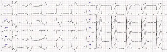 This diagnostic image is a 12-lead electrocardiogram (ECG) demonstrating signs consistent with an acute anterolateral ST-elevation myocardial infarction (STEMI). The precordial leads (V1-V6) show significant ST-segment elevation with a convex upward morphology, particularly prominent in V2 through V5, where the elevated segments merge into peaked T-waves. In the limb leads, there is ST-segment elevation in leads I and aVL, representing the lateral wall of the heart. Reciprocal ST-segment depression is visible in lead aVR. Pathological Q-waves are observed in several leads, including I, II, III, aVL, and aVF, suggesting areas of myocardial necrosis or evolving infarction. The QRS complexes exhibit some widening but maintain a recognizable morphology. This ECG serves as a critical educational tool for identifying the electrical patterns of acute coronary syndromes and localizing myocardial ischemia to the anterior and lateral walls of the left ventricle.