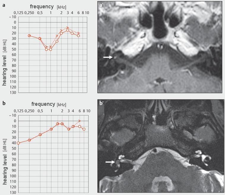 Educational medical composite featuring clinical audiograms and diagnostic MRI images focusing on intralabyrinthine schwannomas. Panel (a) shows a pure-tone audiogram demonstrating a mid-frequency 'cookie-bite' sensorineural hearing loss. Corresponding axial T1-weighted contrast-enhanced MRI (a') reveals a focal, hyperintense enhancing mass within the right cochlea (arrow), consistent with an intracochlear schwannoma. Panel (b) shows an audiogram with low-frequency sensorineural hearing loss. The associated axial T2-weighted MRI (b') identifies a small, hypointense filling defect in the high-signal fluid of the right vestibule (arrow), diagnostic of an intravestibular schwannoma. These images illustrate the correlation between specific inner ear tumor locations and their characteristic audiological presentations. The radiological views highlight the importance of thin-section temporal bone imaging in detecting small intralabyrinthine lesions that may present with symptoms mimicking idiopathic sudden sensorineural hearing loss or Meniere's disease.