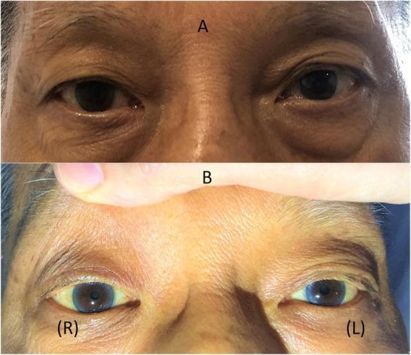 Two-panel clinical photograph demonstrating Horner’s syndrome in a patient. Panel A shows the patient's eyes at rest, highlighting a mild right-sided ptosis (drooping of the upper eyelid) and a subtle 'upside-down ptosis' (elevation of the right lower eyelid). Panel B provides a close-up view of the eyes with the upper eyelids manually retracted to reveal anisocoria; the right pupil (labeled R) is significantly smaller (miotic) compared to the left pupil (labeled L). The clinical findings illustrate the classic triad of sympathetic denervation: ptosis, miosis, and enophthalmos appearance due to narrowing of the palpebral fissure. This visual evidence supports a diagnosis of Horner’s syndrome, often associated with neurological or vascular pathology affecting the oculosympathetic pathway. The image serves as an educational tool for identifying autonomic ocular dysfunction in neurology and ophthalmology.