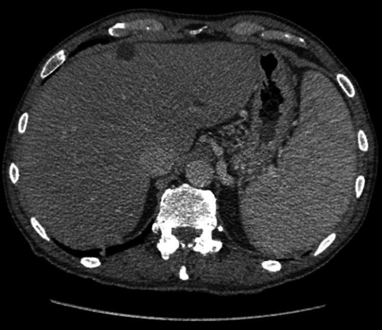 This diagnostic image is an axial slice from a non-contrast Computed Tomography (CT) scan of the upper abdomen. The primary findings are indicative of chronic liver disease and portal hypertension. The liver demonstrates a nodular, irregular contour and heterogeneous parenchymal texture characteristic of cirrhosis. Marked splenomegaly is present, with the spleen significantly enlarged and extending anteriorly and laterally. Several vascular findings suggest portal venous hypertension, including the visualization of prominent collateral vessels and a thickened gallbladder wall. A small amount of perihepatic ascites is visible as a low-attenuation fluid rim. The scan provides clinical evidence of systemic manifestations of liver dysfunction, suitable for medical education regarding the radiological presentation of cirrhotic morphology and secondary effects on the portal venous system.