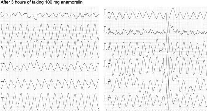 A 12-lead electrocardiogram (ECG) demonstrating a wide-complex tachycardia consistent with monomorphic ventricular tachycardia (VT). The recording shows a regular, rapid ventricular rate of approximately 202 beats per minute. Key diagnostic features include markedly prolonged QRS complexes (measured at 280 ms), indicative of significantly delayed ventricular depolarization. In most leads, including limb leads (I, II, III, aVR, aVL, aVF) and precordial leads (V1, V3-V6), the QRS morphology is uniform and repetitive with a characteristic 'sine-wave' appearance in certain leads. Lead V2 shows lower voltage or less discernible complexes compared to the others. There is a complete absence of preceding P waves, confirming a non-sinus origin of the rhythm. The clinical significance of this ECG relates to drug-induced sodium channel blockade (anamorelin toxicity), causing life-threatening ventricular arrhythmia and hemodynamic instability. The visual data is essential for medical education regarding wide QRS tachycardia differential diagnosis and the recognition of drug-related cardiotoxicity.