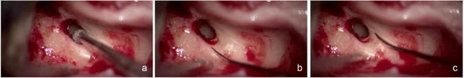 A series of three intraoperative clinical photographs showing a posterior tympanotomy (facial recess approach) in a right ear, a critical step in cochlear implant surgery. Panel A demonstrates a 2 mm surgical diamond burr positioned within the facial recess opening, serving as a scale to indicate adequate surgical dimensions for instrument access. Panels B and C highlight the critical anatomical landmarks surrounding the opening: the facial nerve (FN) is clearly identifiable on the posterior margin with an intact posterior external auditory canal wall, and the chorda tympani nerve (CTN) defines the anterior-superior border. Through the surgically created window, the round window (RW) is visualized posteroinferiorly, providing the target site for electrode insertion into the basal turn of the cochlea. The series illustrates a 'normal' surgical view where all anatomical boundaries are preserved and the round window is easily accessible for direct membrane insertion. This content is intended for otolaryngology surgical training and preoperative planning.