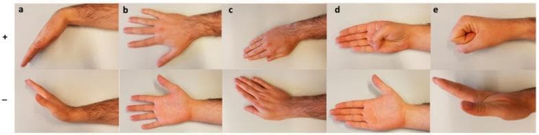 This clinical photograph series demonstrates the range of motion (ROM) assessment for the human hand and wrist, categorized into five distinct movements (a-e). The top row (+) represents positive directional movements, while the bottom row (-) represents negative directional movements. (a) Wrist Flexion (+) and Extension (-): illustrating palmar and dorsal angulation of the radiocarpal joint. (b) Radial (+) and Ulnar (-) Deviation: showing lateral movement of the hand toward the radius and ulna respectively. (c) Pronation (+) and Supination (-): demonstrating rotation of the forearm resulting in palm-down and palm-up orientations. (d) Thumb Flexion (+) and Extension (-): focusing on the movement of the metacarpophalangeal (MCP) and interphalangeal (IP) joints of the thumb. (e) Finger Flexion (+) and Extension (-): showing the transition from a closed fist to fully extended fingers, involving the MCP, proximal interphalangeal (PIP), and distal interphalangeal (DIP) joints. This visual serves as a standardized reference for clinical orthopedic examination and kinesiologic evaluation.