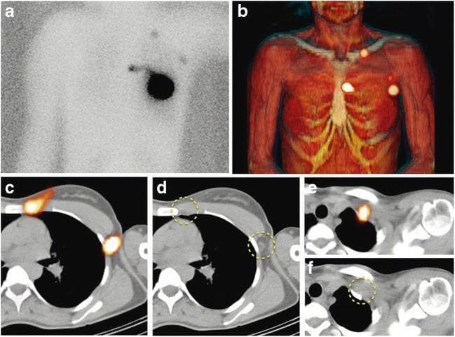 This composite diagnostic image demonstrates preoperative sentinel lymph node (SLN) mapping using 99mTc-nanocolloid SPECT/CT in a 63-year-old woman with breast cancer. Panel (a) shows planar lymphoscintigraphy with body contouring, revealing an intense area of tracer uptake at the intratumoral injection site in the left breast and weaker focal uptake indicating lymphatic drainage to the axillary, periclavicular, and internal mammary chains. Panel (b) presents a 3D surface volume rendering SPECT/CT, which provides a topographic view of the SLNs (bright orange foci) localized relative to the skin surface and skeletal structures. Lower panels (c-f) provide transaxial SPECT/CT and corresponding CT slices, allowing for precise anatomical correlation. These sections localize specific SLNs to the second intercostal space (internal mammary chain), level I of the left axilla, and the retroclavicular region, with yellow dashed circles highlighting the anatomical correlates on the CT images. The study illustrates the incremental value of SPECT/CT in providing high-resolution anatomical localization of sentinel nodes compared to planar scintigraphy.