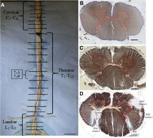 This composite educational image illustrates spinal cord gross anatomy and histopathological analysis of demyelination in Multiple Sclerosis (MS). Panel A shows a gross spinal cord dissection with labeling of cervical (C1-C8), thoracic (T1-T12), and lumbar (L1-L5) segments, indicating axial sectioning levels. Panels B and C present healthy control sections at the cervical and upper thoracic levels respectively. Panel B (SMI-31 stain) outlines the gray matter (GM) in red and cross-sectional area (CSA) in blue to calculate white matter (WM) volume. Panel C (MBP stain) demonstrates normal myelin distribution. Panel D displays an MS upper thoracic section stained for Myelin Basic Protein (MBP), highlighting localized pathology. Five demyelinated plaques are manually delineated: one large gray matter lesion (GM Lesion 1) and four distinct white matter lesions (WM Lesions 1-4). These microscopic sections (4x magnification) serve to teach quantitative assessment of demyelination and atrophy in neuroinflammatory disease. Key concepts include neuroanatomical mapping, immunohistochemical staining for axonal integrity (SMI-31) and myelin (MBP), and the identification of focal MS plaques.