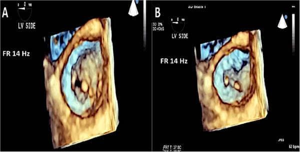 This diagnostic image consists of two panels (A and B) featuring 3D transesophageal echocardiography (TEE) of the mitral valve, captured from the left ventricular (LV) perspective. The imaging demonstrates classic features of rheumatic mitral disease. Panel A shows the mitral valve in diastole, where the orifice appears relatively open and rounded, yet displays thickened leaflet margins. Panel B shows the valve in systole, demonstrating restricted leaflet motion and a characteristic 'fish mouth' or slit-like configuration of the valve orifice, which is typical of commissural fusion and rheumatic remodeling. Technical annotations indicate a frame rate (FR) of 14 Hz, a heart rate of 62 bpm, and a patient temperature (PAT T) of 37.0°C. This comparison illustrates the transition between diastolic opening and systolic restricted closure, highlighting the structural pathology that leads to both mitral stenosis and regurgitation in rheumatic heart disease.