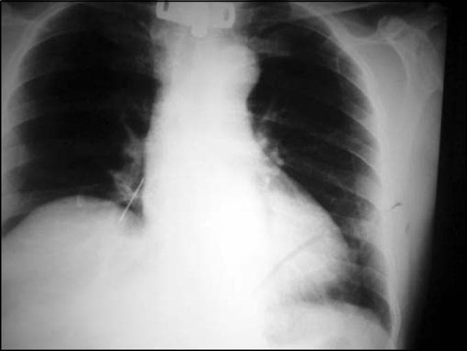 This diagnostic image is a posteroanterior (PA) chest X-ray demonstrating a radiopaque foreign body aspiration. The primary finding is a linear, high-density metallic object located in the right lower lung field, consistent with the anatomical position of the right inferior lobar or segmental bronchus. The surrounding lung parenchyma appears largely clear, with no immediate evidence of distal atelectasis, obstructive hyperinflation, or consolidation in this projection. The cardiac silhouette and mediastinum are within normal limits of size and position. A tracheostomy cannula or related medical hardware is partially visible at the top of the image in the midline tracheal position. The bony structures, including the ribs and clavicles, appear intact. This radiograph serves as a clinical example of foreign body localization in the tracheobronchial tree, highlighting the use of plain film radiography in identifying aspirated metallic materials and assessing for secondary pulmonary complications like pneumonia or collapse.