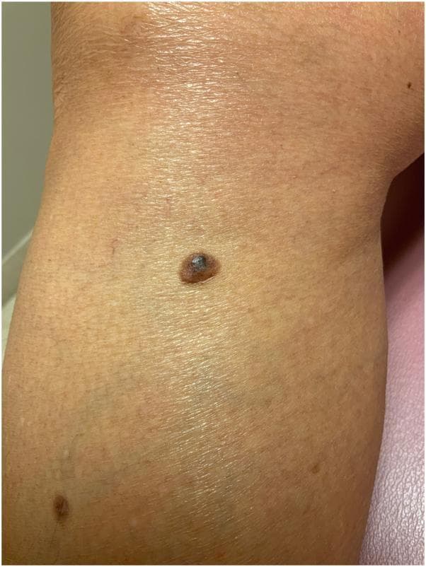 Clinical photograph of a lower extremity, specifically the leg, featuring a primary pigmented lesion characteristic of a dermatofibroma. The lesion is a solitary, well-circumscribed papule showing a distinctive variegated appearance: a dark, hyperpigmented, almost black central area surrounded by a lighter brown peripheral rim. The borders are well-defined and appear slightly elevated. The skin surface over the lesion exhibits some subtle texture changes. In the surrounding cutaneous field, several smaller, less prominent, and lighter-colored pigmented macules are visible, providing a comparison to the primary lesion's morphology. This image serves as a clinical example of a dermatofibroma, illustrating the classic central hyperpigmentation and firm, elevated borders often encountered in this benign fibrous histiocytoma of the dermis.